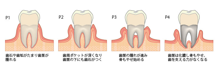 画像に alt 属性が指定されていません。ファイル名: periodontosis_ph01.jpg